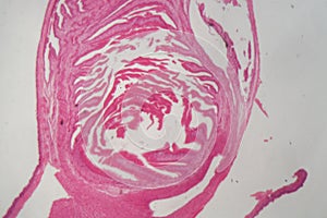 Hydatide cyst of cyclophyllid tapeworm Echinococcus