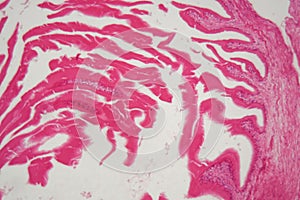 Hydatide cyst of cyclophyllid tapeworm Echinococcus