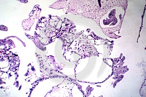 Hydatiform mole, light micrograph