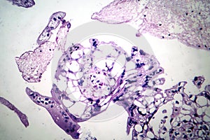 Hydatiform mole, light micrograph