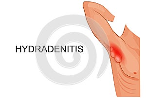 Hydradenitis. inflammation of the sweat glands.