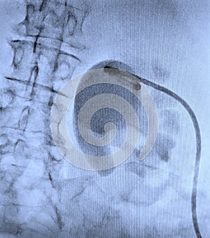 Hydronephrosis pyelostomy tube ureter obstruction