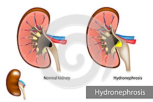 Hydronephrosis. Urinary Tract Dilation