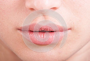 Hylauronic acid or botox female lips