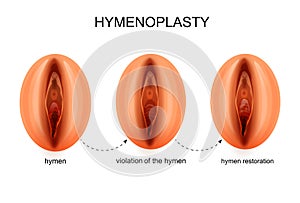 Hymen restoration