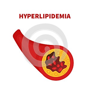 Hyperlipidemia of artery vessel blocked with a clot photo