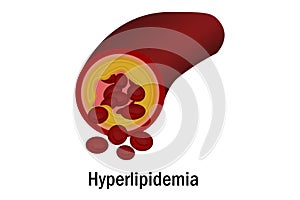 Hyperlipidemia with blood vessel isolated photo