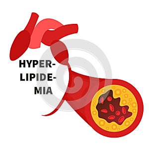 Hyperlipidemia conceptual illustration of blocked blood artery vessel photo