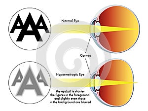 Hypermetropia photo