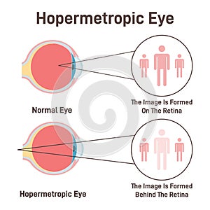 Hypermetropic astigmatism. Hyperopic eye vision with comparison