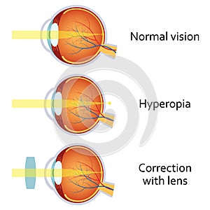 Hyperopia corrected by a plus lens