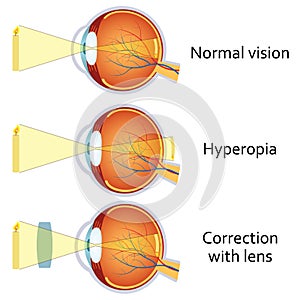 Hyperopia corrected by a plus lens. photo