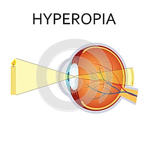 Hyperopia eyesight disorder. photo