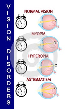 Hyperopia and Hyperopia corrected by a plus lens. Eye vision disorder photo
