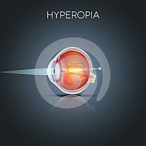 Hyperopia, long sighted eye