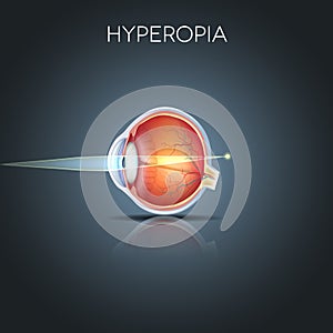 Hyperopia, long sighted eye photo