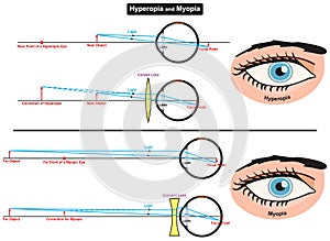 Hyperopia and myopia human eye disease infographic diagram medical science photo