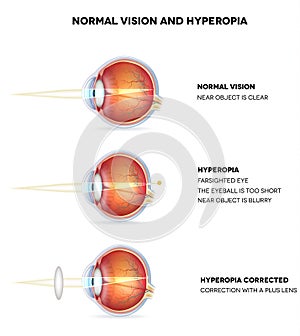 Hyperopia and normal vision photo