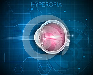 Hyperopia, vision disorder photo