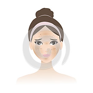 Hyperpigmentation and melasma is on the woman face vector illustration isolated on white background.