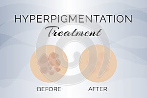 Hyperpigmentation Treatment Before and After Illustration Design photo