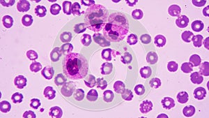 Hypersegmented neutrophil is a clinical seen . It is drawing blood from a patient and view the blood smear under a