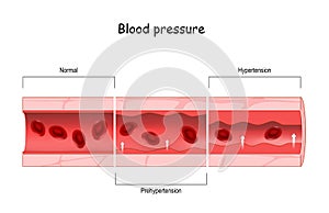 Hypertension. high blood pressure. Cross section of blood vessel with red blood cells