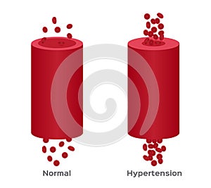 Hypertension , high blood pressure / human anatomy