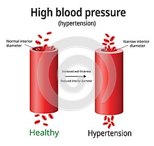 Hypertension, high blood pressure vector,