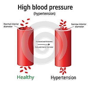 Hypertension, high blood pressure vector, photo