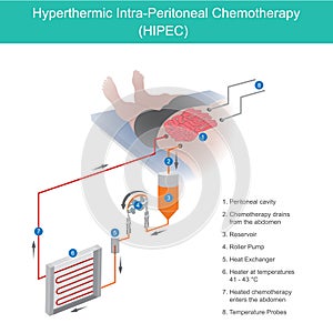 Hyperthermic Intra Peritoneal Chemotherapy. The use of chemotherapy to destroy intestine cancer cells through fluid in the abdomen