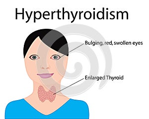 Hyperthyroidism. Enlarged Thyroid. Endocrine disfunction vector