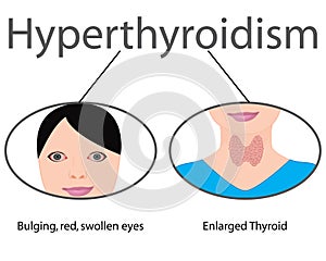 Hyperthyroidism. Enlarged Thyroid. Endocrine disfunction vector illustration