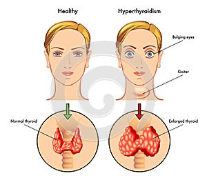 Hyperthyroidism photo