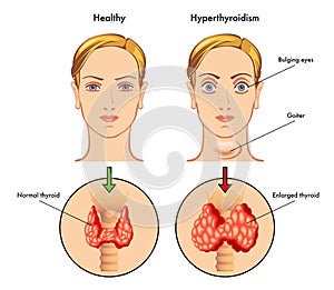 Hyperthyroidism