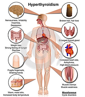 Hyperthyroidism medical vector illustration isolated on white background infographic
