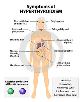 Hyperthyroidism or over active thyroid. hyperthyreosis