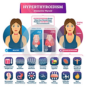 Hyperthyroidism vector illustration. Labeled medical thyroid gland disease.