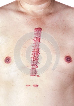 The hypertrophic big scar or swell cicatrix.