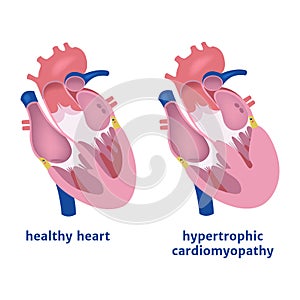 Hypertrophic cardiomyopathy.