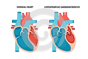 Hypertrophic cardiomyopathy with cross-section view. Human heart muscle diseases. Cardiology concept.