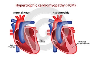 Hypertrophic cardiomyopathy, Heart disease, Vector image