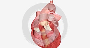 Hypertrophic cardiomyopathy occurs when the muscle cells of the heart enlarge causing the walls of ventricles to thicken