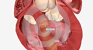 Hypertrophic cardiomyopathy occurs when the muscle cells of the heart enlarge causing the walls of ventricles to thicken