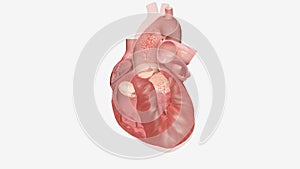 Hypertrophic cardiomyopathy occurs when the muscle cells of the heart enlarge causing the walls of ventricles to thicken