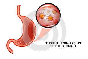 Hypertrophic polyposis of the stomach