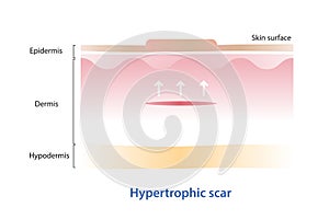 Hypertrophic scar on skin surface vector illustration isolated on white background.