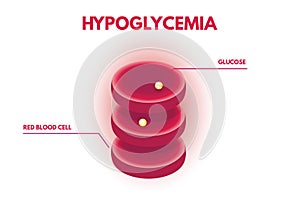 Hypoglycemia, Human glucose levels isometric. photo