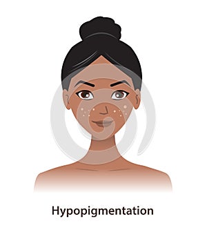 Hypopigmentation and white spots on woman face vector isolated on white background.