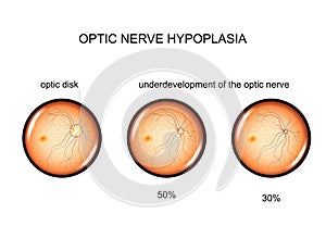 Hypoplasia of the optic nerve